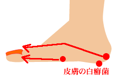 皮膚の白癬菌